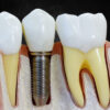 implant crown & bridge