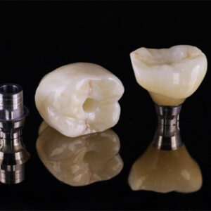implant crown & bridge