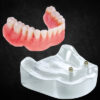 implant overdenture