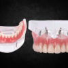 implant overdenture