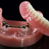 implant overdenture