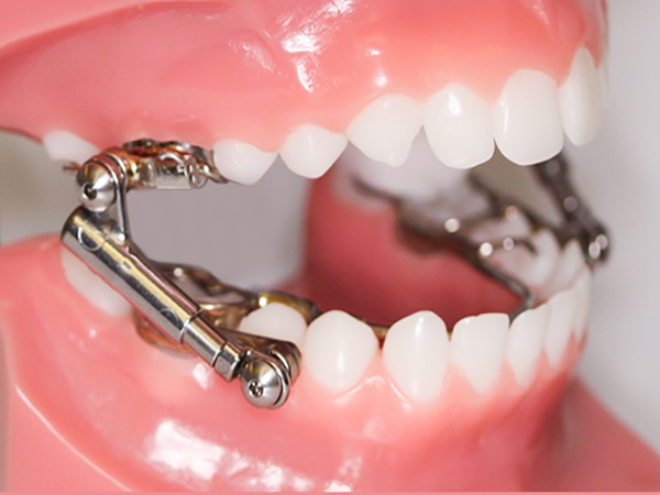 Dental Appliance