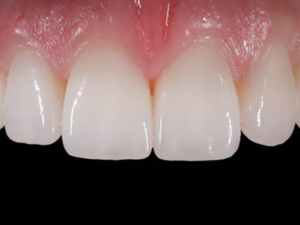 E.max Veneers