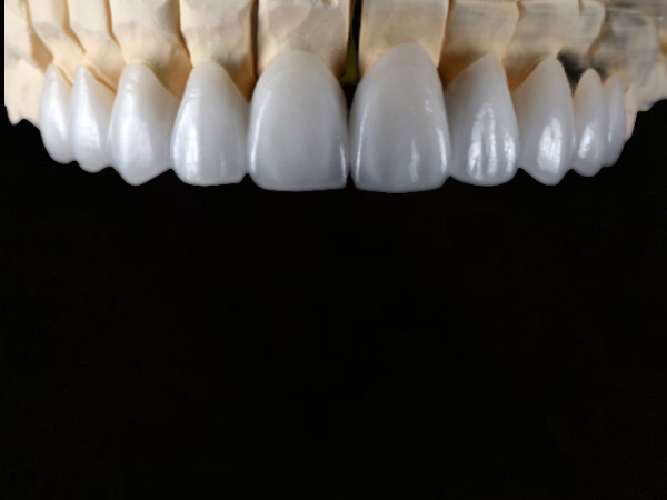 Zirconia Veneers