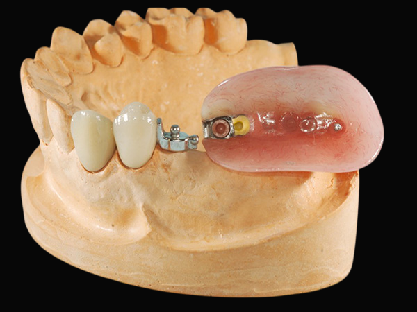 Preci vertix Attachment
