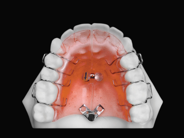 Removable Expander