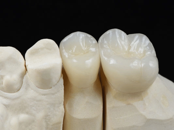 full zirconia