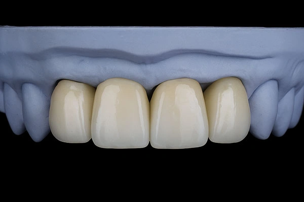 Composite Resin Veneers