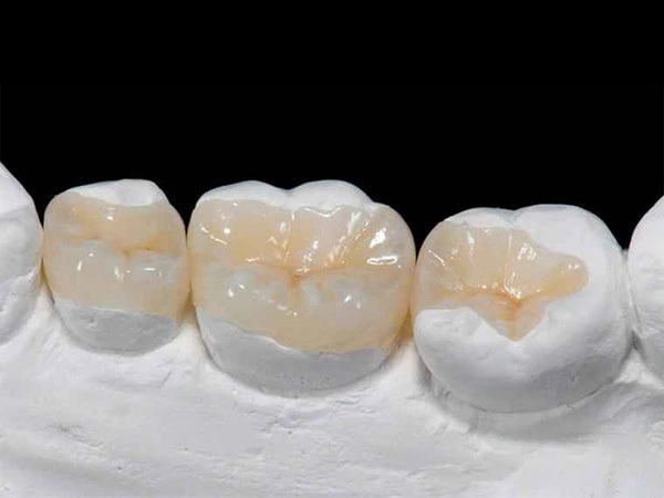Zirconia Inlays Onlays