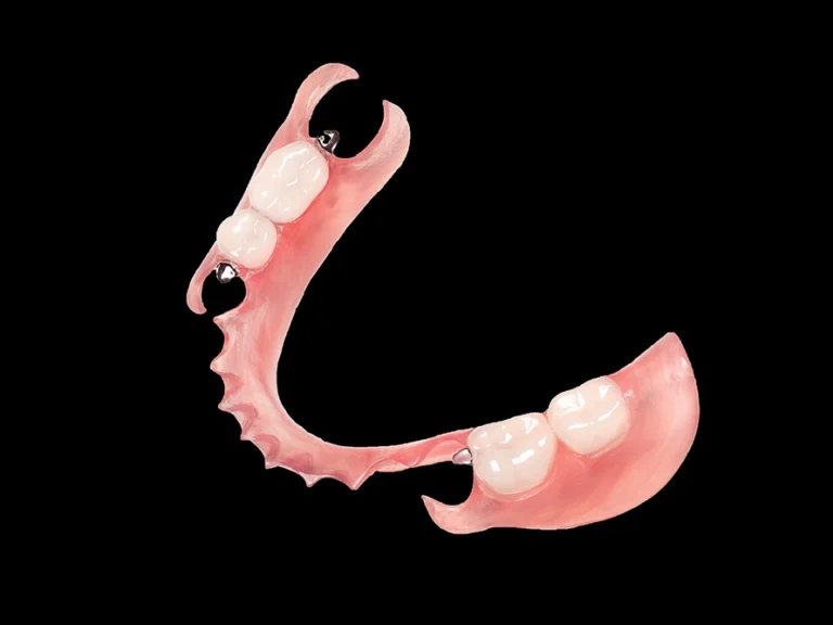 valplast partial