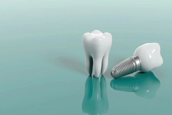 Dental Implant Brands