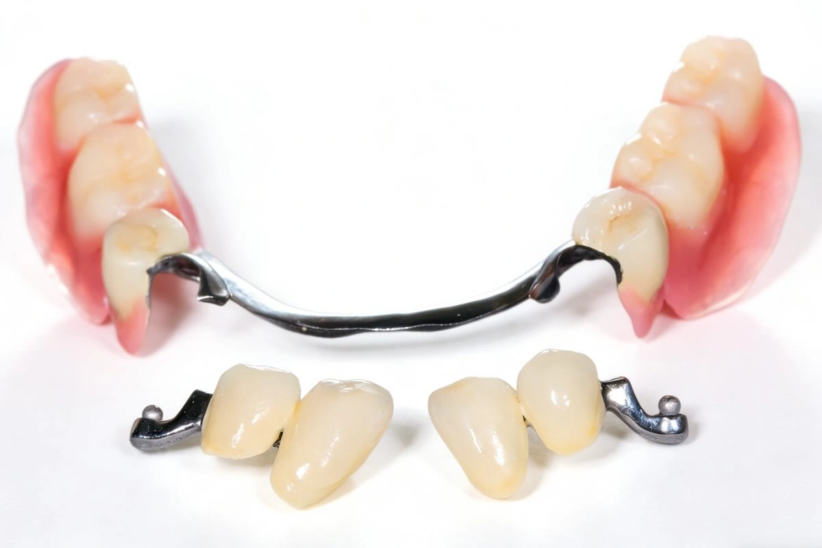 Precision Dental Attachment Outsourcing