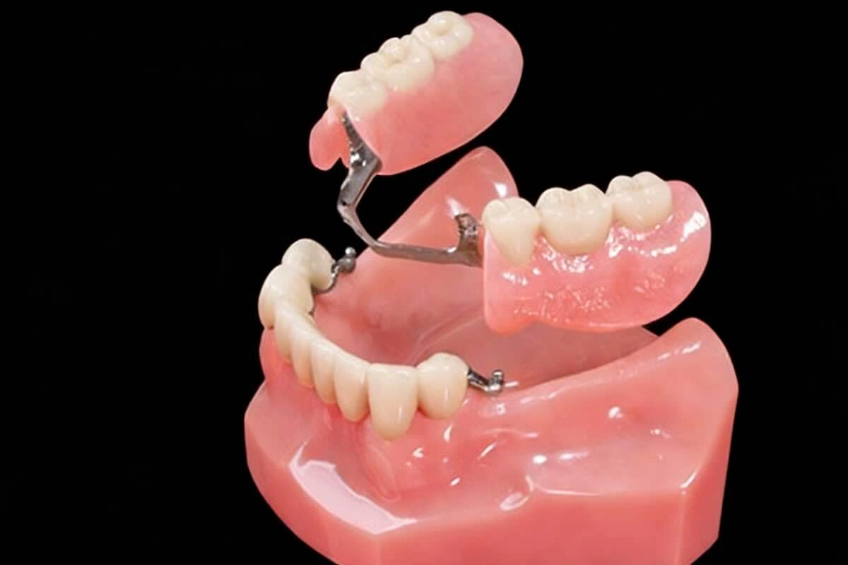 Precision Dental Attachment Outsourcing