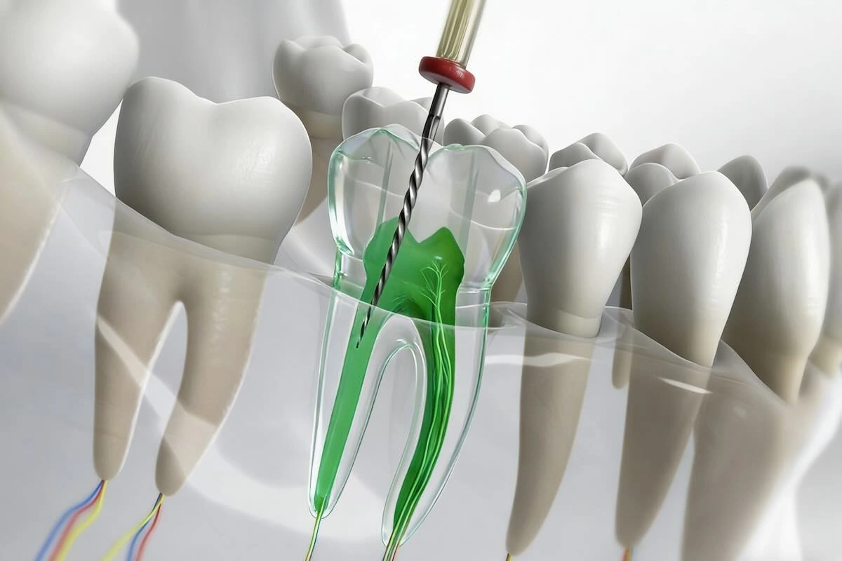 Post and Core Outsourcing Guide