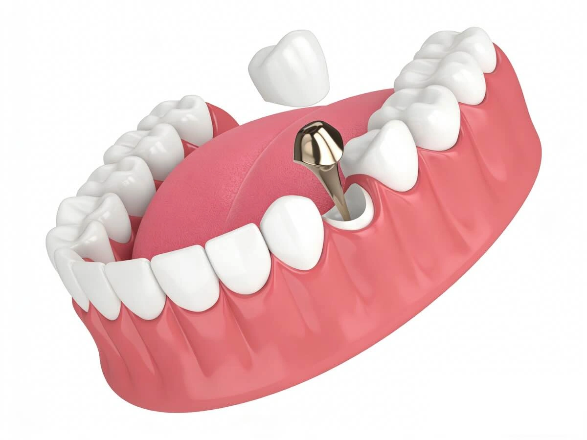 Post and Core Outsourcing Guide