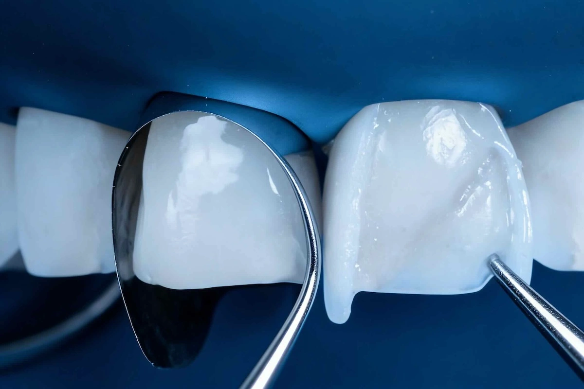 Dental Veneers Outsourcing