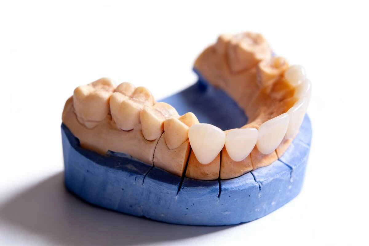 Temporary Restorations Outsourcing