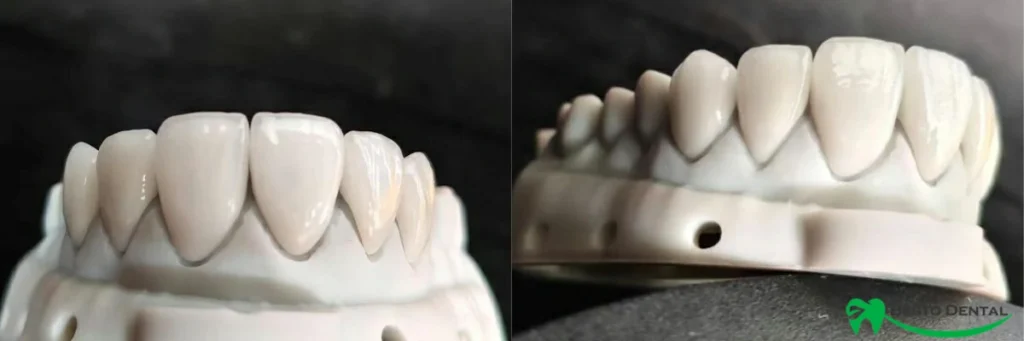E.max Veneer