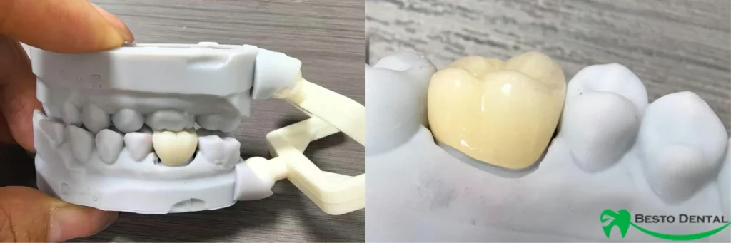 Full Contour Zirconia Crown