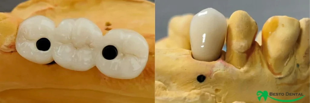Implant Restorations