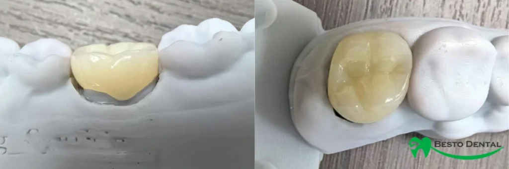 Layered Zirconia Crown