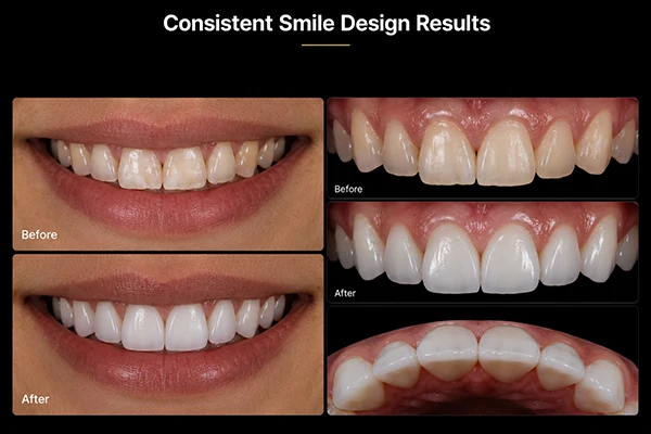 Consistent Smile Design Results