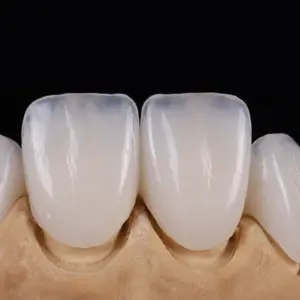 High-Translucency Zirconia Veneers
