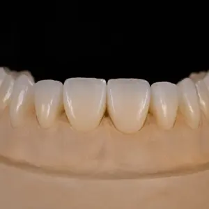 Multilayer Zirconia Veneers
