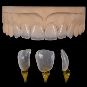 Ultra-Thin Zirconia Veneers