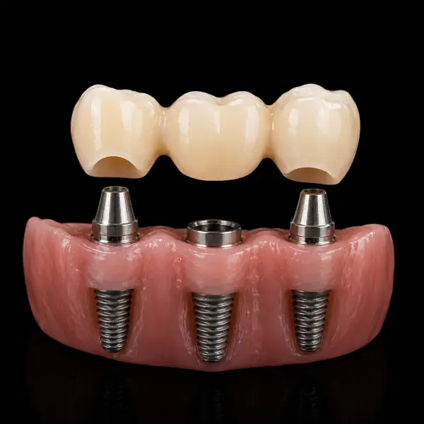 3-Unit Implant-Supported Zirconia Bridge