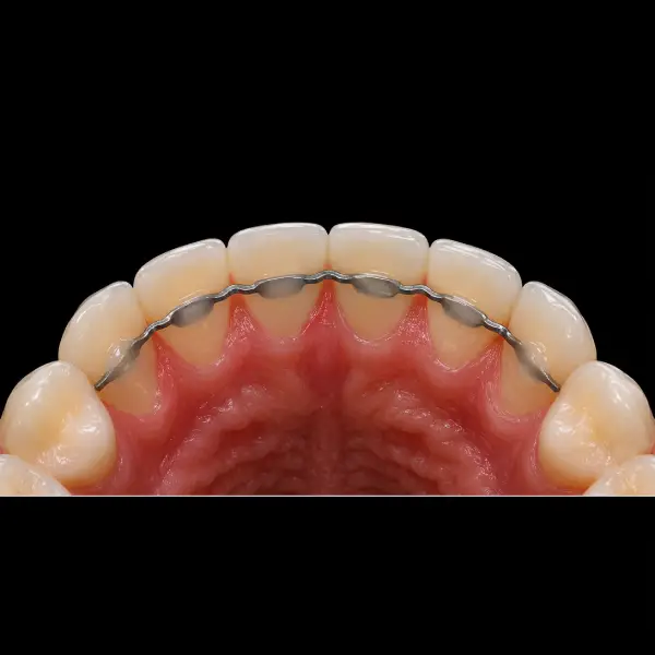 CAD/CAM Lingual Retainer
