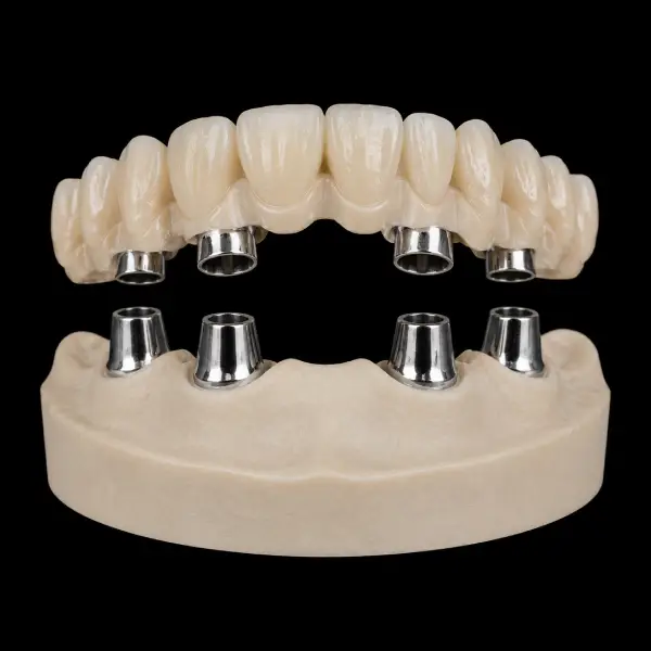 CAD/CAM Telescopic Bridge