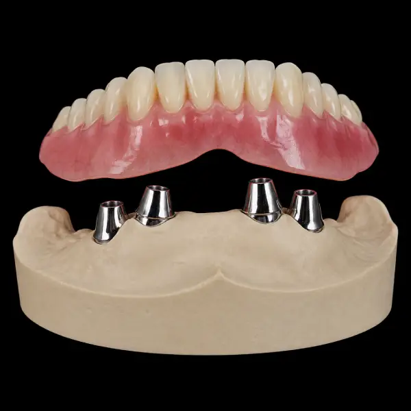 CAD/CAM Telescopic Partial Denture