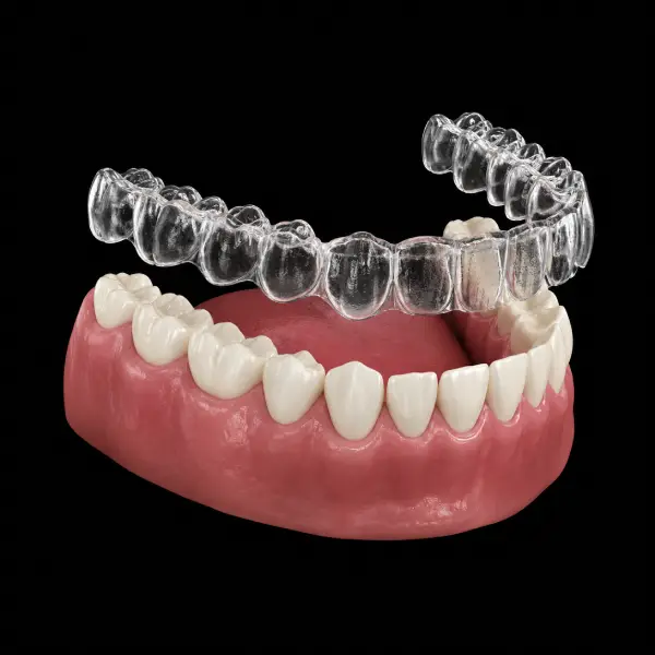 Clear Aligner with IPR Plan