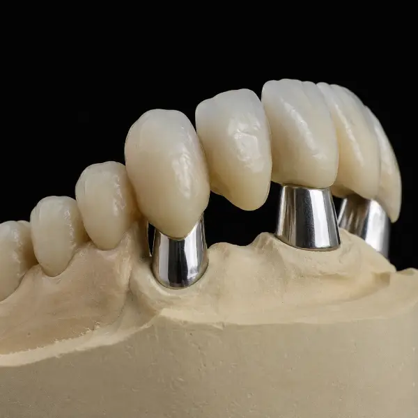 Conical (Konus) Cobalt-Chrome Telescopic Crowns