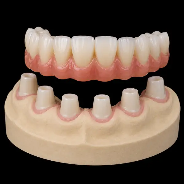 Conical (Konus) Zirconia Telescopic Crowns