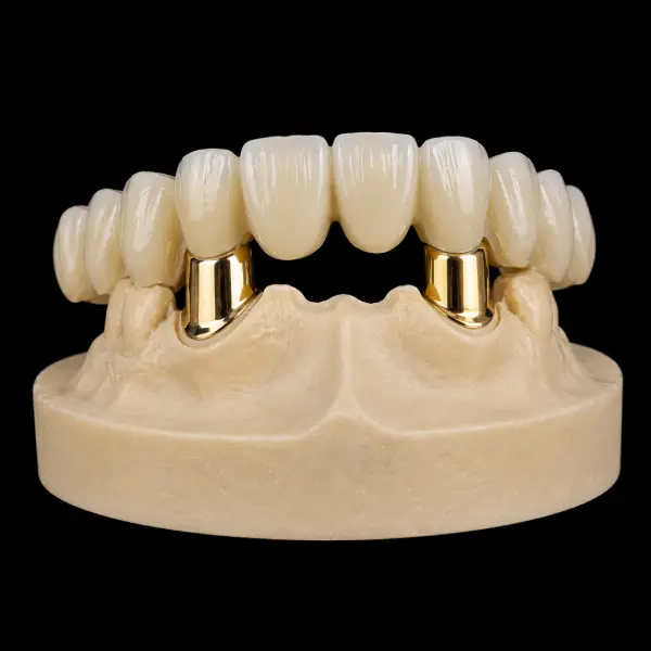 Conical Yellow Gold Telescopic Crowns