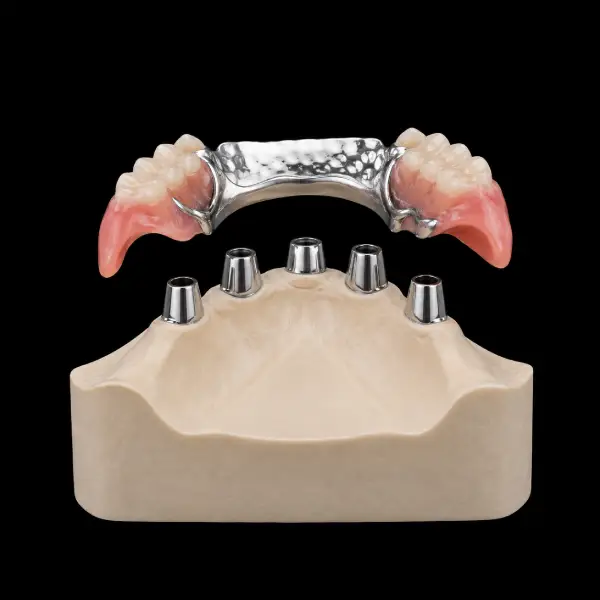 Conventional Telescopic Partial Denture