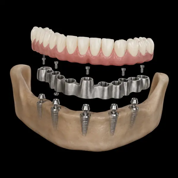 Custom CADCAM Titanium Framework