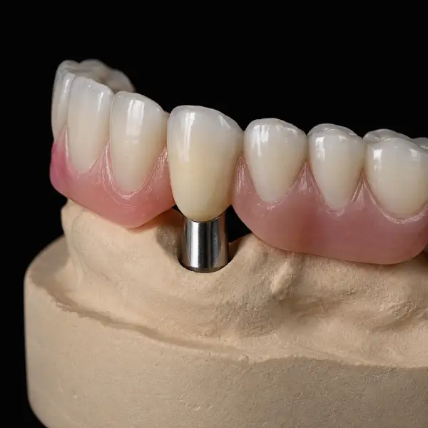 Cylindrical Cobalt-Chrome Telescopic Crowns