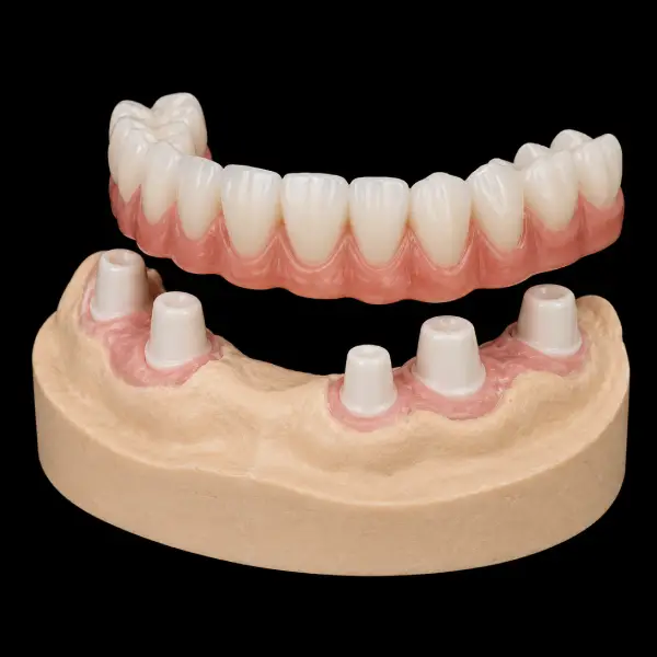 Conical (Konus) Zirconia Telescopic Crowns