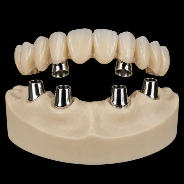 Double Crown Telescopic Bridge System