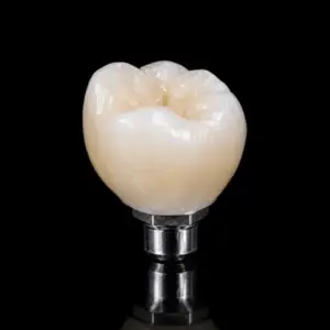 Full Contour Screw-Retained Zirconia Crown