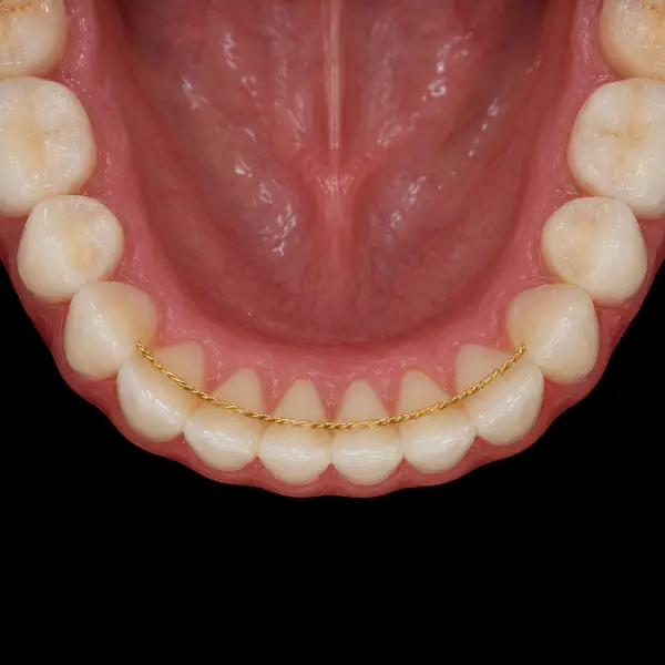 Gold Lingual Retainer
