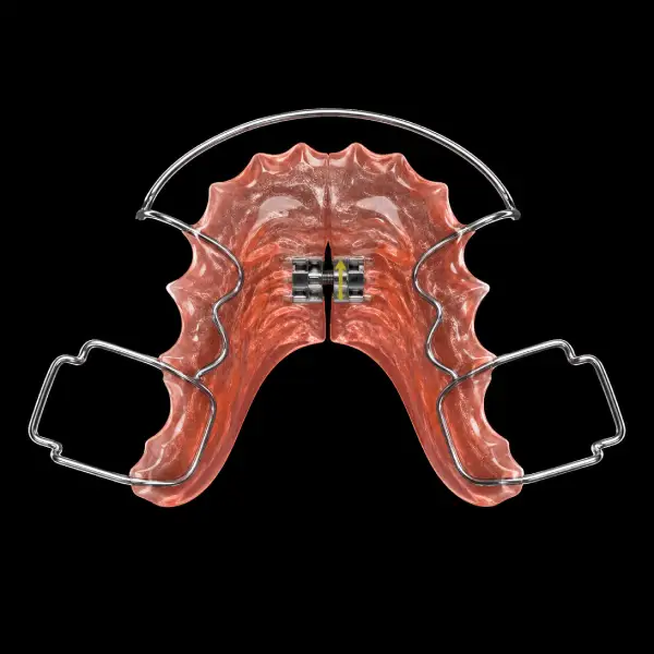 Hawley Retainer with Expansion Screw