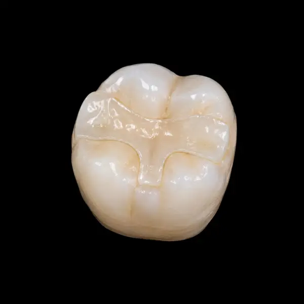 High-Translucency E.max Inlay