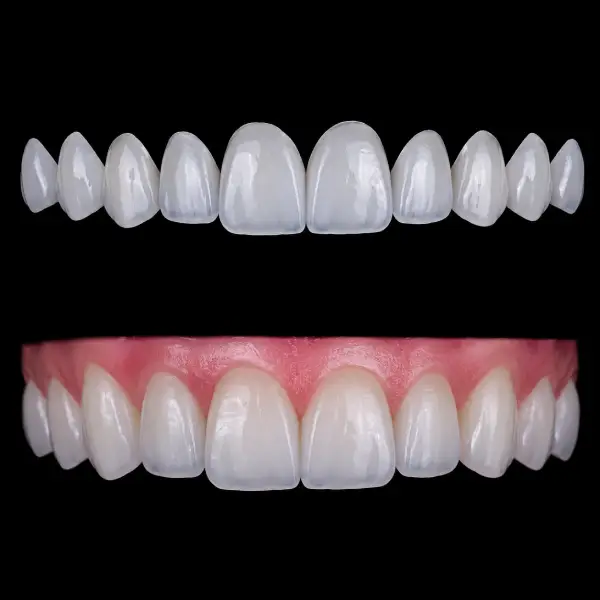 High-Translucency E.max Veneers