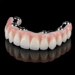 High Translucency Implant-Supported Zirconia Bridge
