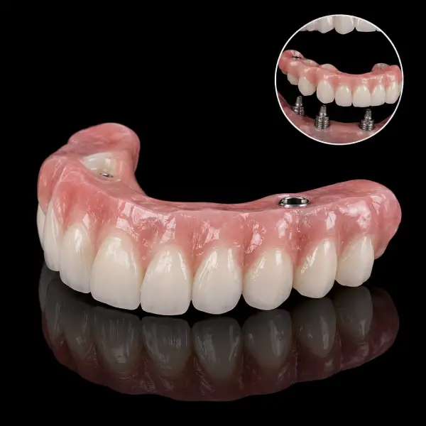 Immediate Load Temporary Teeth with Gum