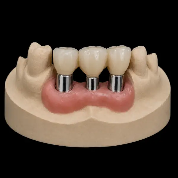 Implant-Assisted Cobalt-Chrome Telescopic Crowns